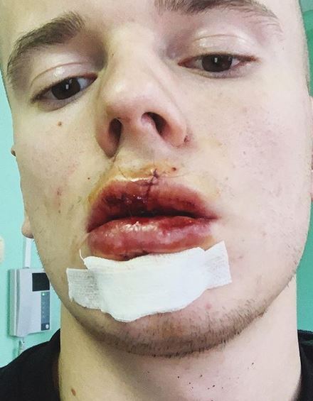 Арсений Шульгин на операционном столе: в Инстаграм появилось кровавое фото сына Валерии