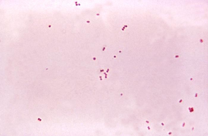 Менінгококовий сепсис: що за інфекція вбила Аллу Вербер, симптоми і фото