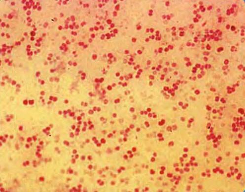 Менінгококовий сепсис: що за інфекція вбила Аллу Вербер, симптоми і фото