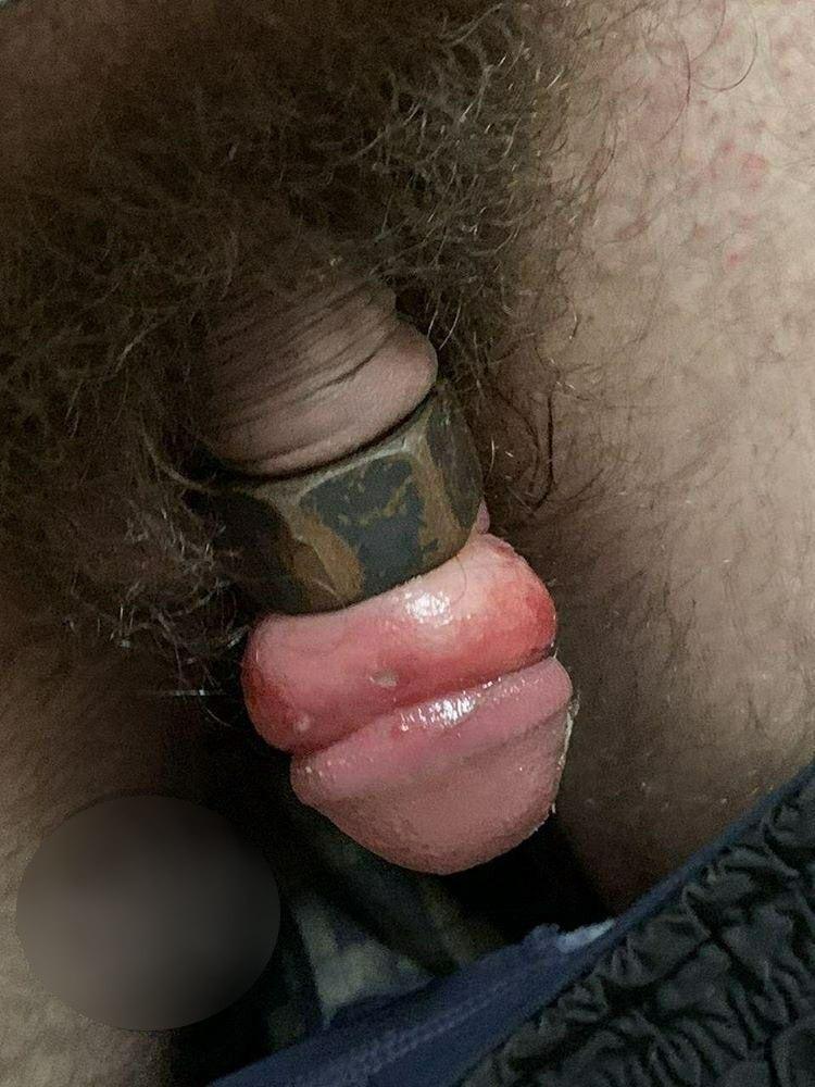 Опубликованы фото 18+ гайки на пенисе у мужчины в Запорожье