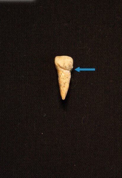 Пример зубного камня на верхнечелюстном резке