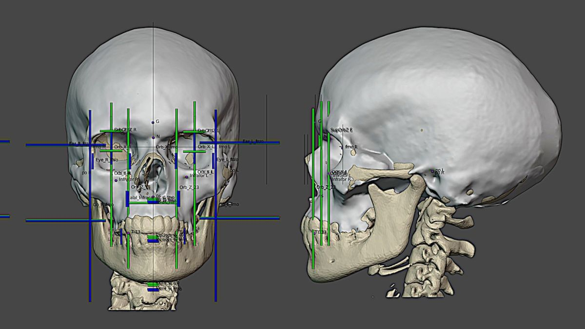 Исследователи использовали проекцию линий, соответствующих границам мягких тканей и костных структур, чтобы создать аппроксимацию лица
