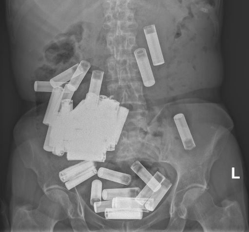 Рентген пациентки, на котором заметно значительное количество батареек в брюшной полости