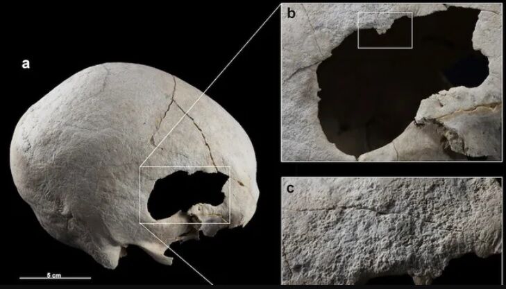 Archaeologists in Spain find evidence that people performed skull surgery 4500 years ago (photo)