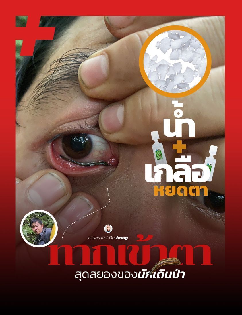 У Таїланді п'явка присмокталася до ока туриста (фото)