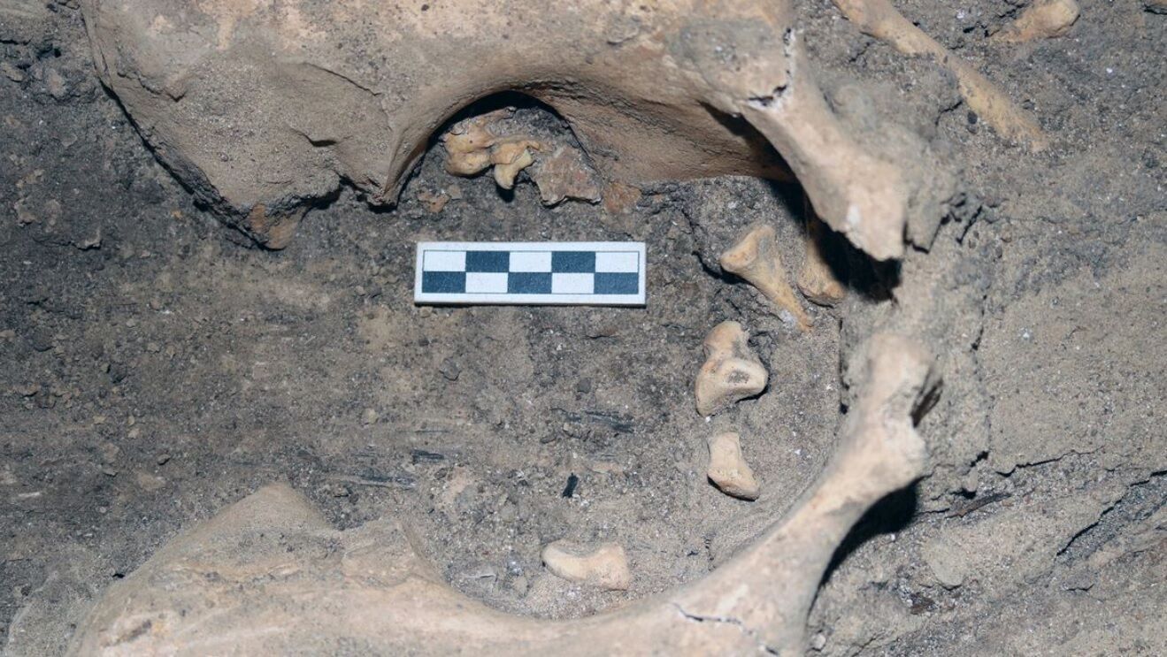 A rare ''tumor with teeth'' that is 3,000 years old has been found in Egypt (photo)