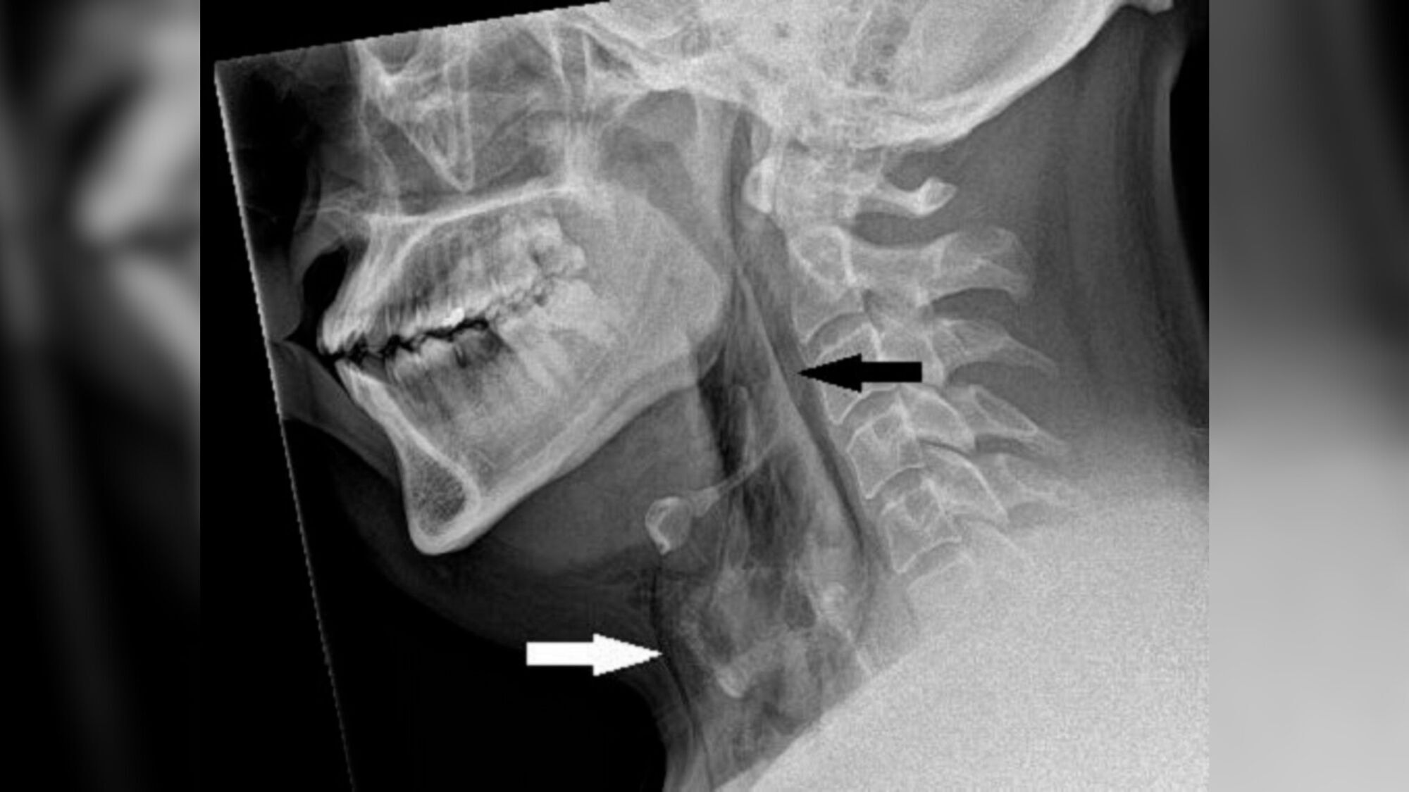 For the first time in the world, a case of tracheal rupture due to ''silent sneezing'' is recorded (photo)