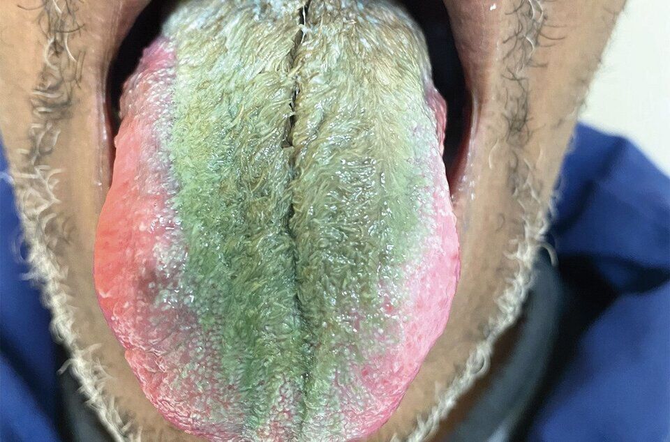 У чоловіка в США позеленів язик та став волохатим: які причини (фото)