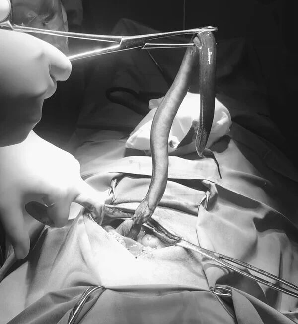 Лікарі під час операції знайшли всередині пацієнта живу 30-сантиметрову істоту (фото)
