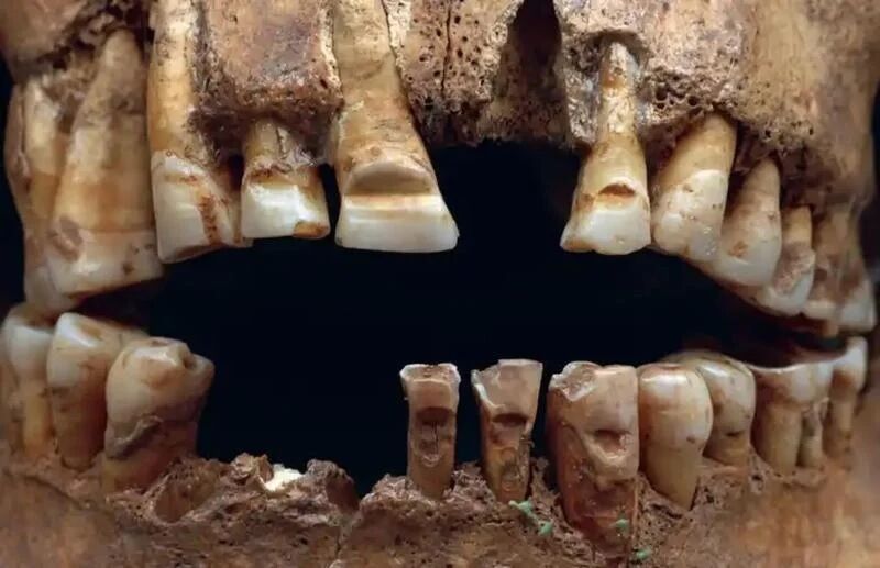 U kobiet z epoki Wikingów odkryto trzy dziwne modyfikacje czaszek (zdjęcie)