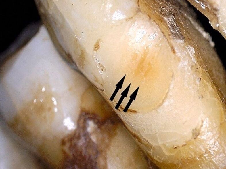 Уникальный протез в возрасте 300 лет был найден в Польше (фото)