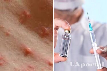 В Минздраве объяснили, что делать, если невакцинированный человек контактировал с больным корью