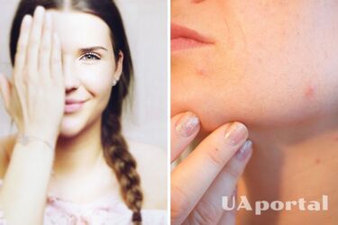 Дерматологиня поділилася порадами, як знизити вплив стресу на шкіру