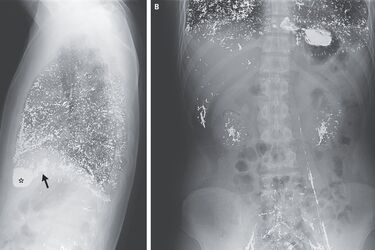 Китаєць ввів ртуть у вену, щоб позбутись лишаю