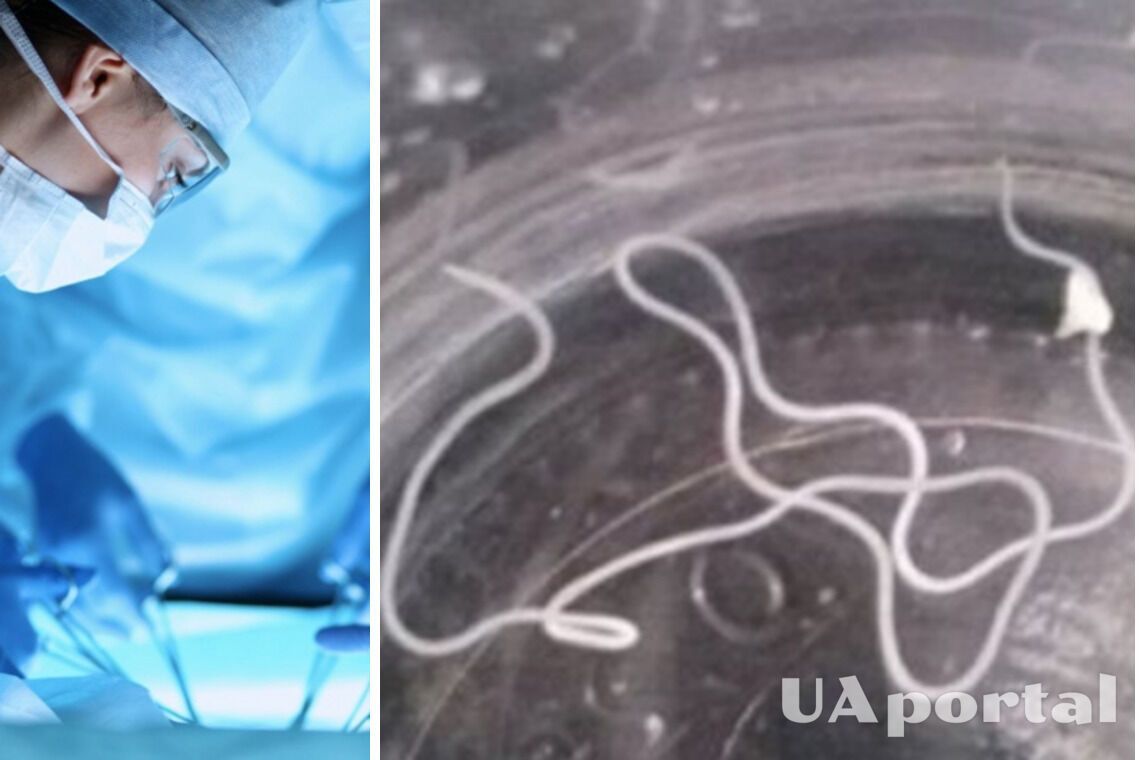 Хирурги получили гельминта длиной 20 см из опухоли жительницы Волынской области