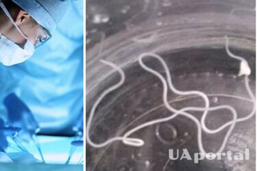 Хірурги дістали гельмінта довжиною 20 см із пухлини мешканки Волинської області