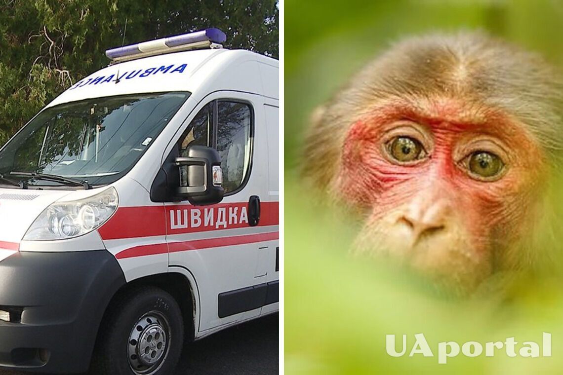 В Україні підтвердили перший випадок віспи мавп