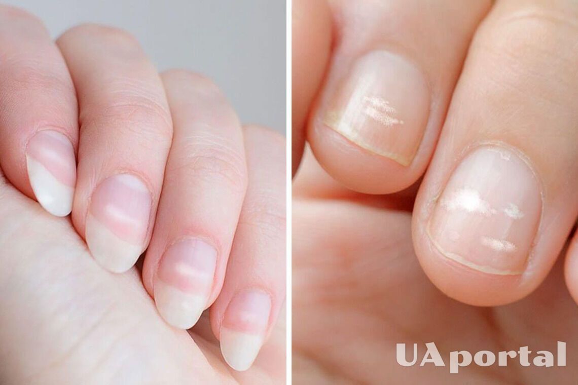 Чому з'являються білі плями на нігтях
