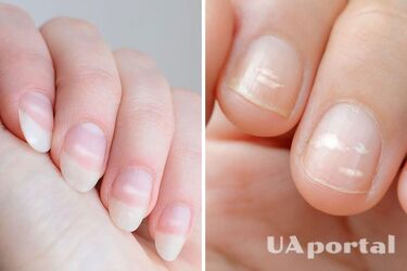 Чому з'являються білі плями на нігтях