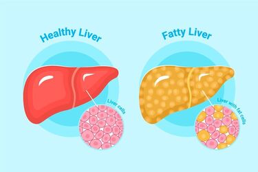 5 tips on how to prevent fatty liver disease