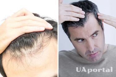 Як запобігти ранньому облисіння у чоловіків