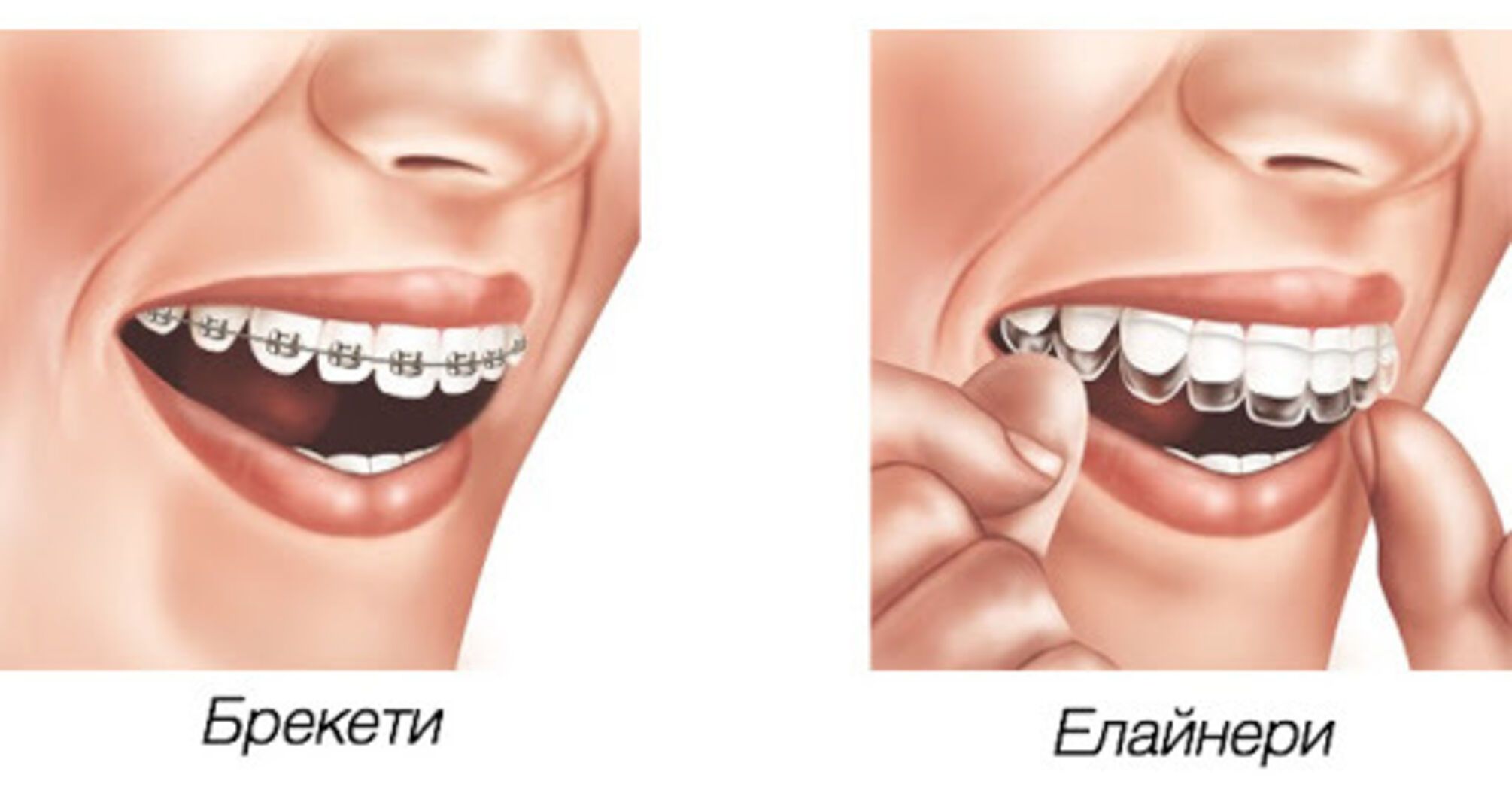 Порівняння елайнерів і брекетів