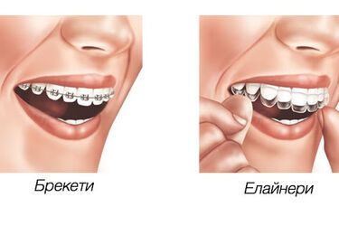 Сравнение элайнеров и брекетов