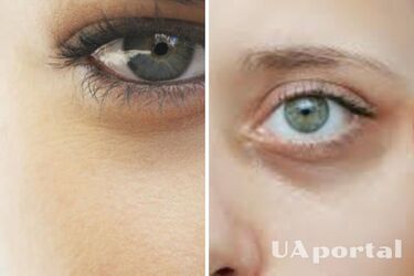 Спеціалісти назвали 4 причини появи темних кіл під очима