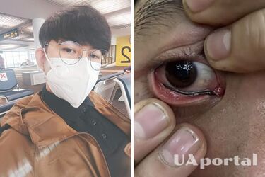 У Таїланді п'явка присмокталася до ока туриста (фото)