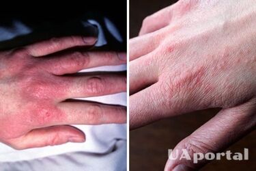 Аллергия на холод: симптомы и методы лечения