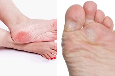 How to lubricate your feet in winter so that the skin does not dry out