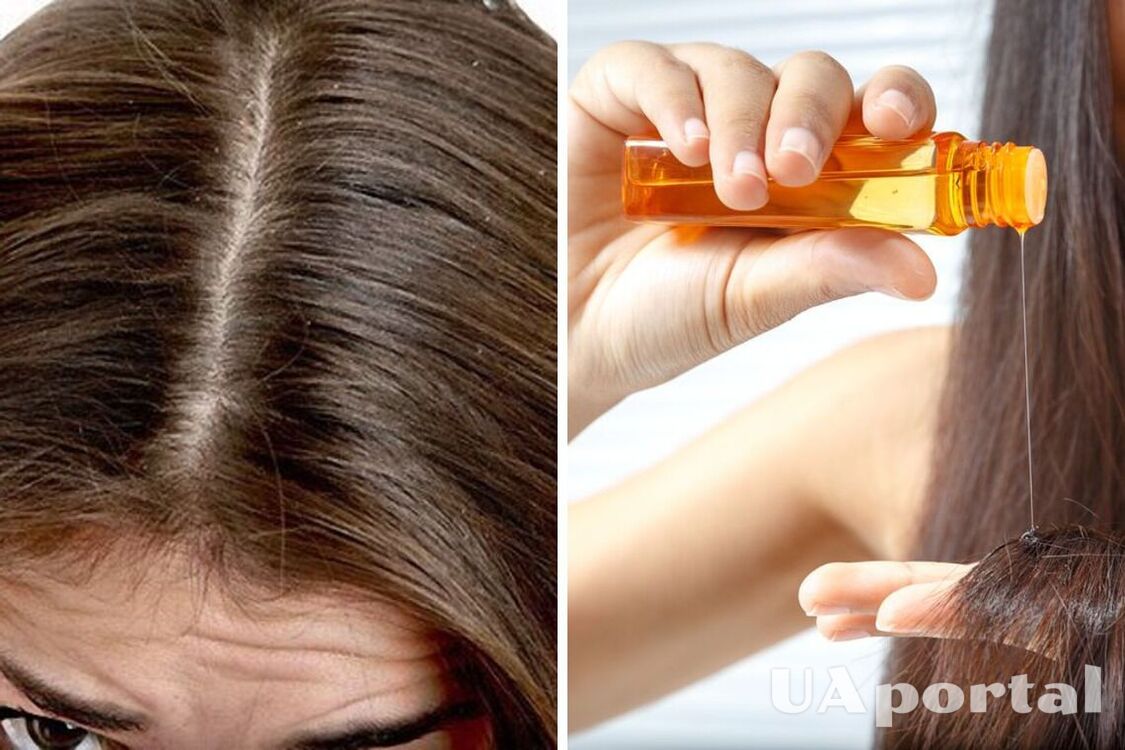 Chamomile and burdock oil: how to get rid of dandruff at home