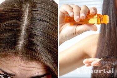 Chamomile and burdock oil: how to get rid of dandruff at home