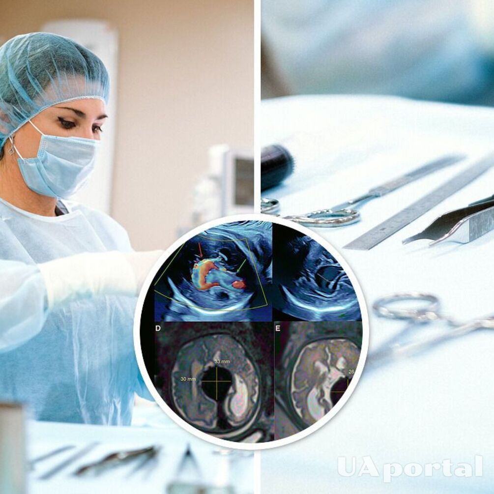 Уникальная операция: врачи прооперировали мозг ребенка, который находился в утробе матери