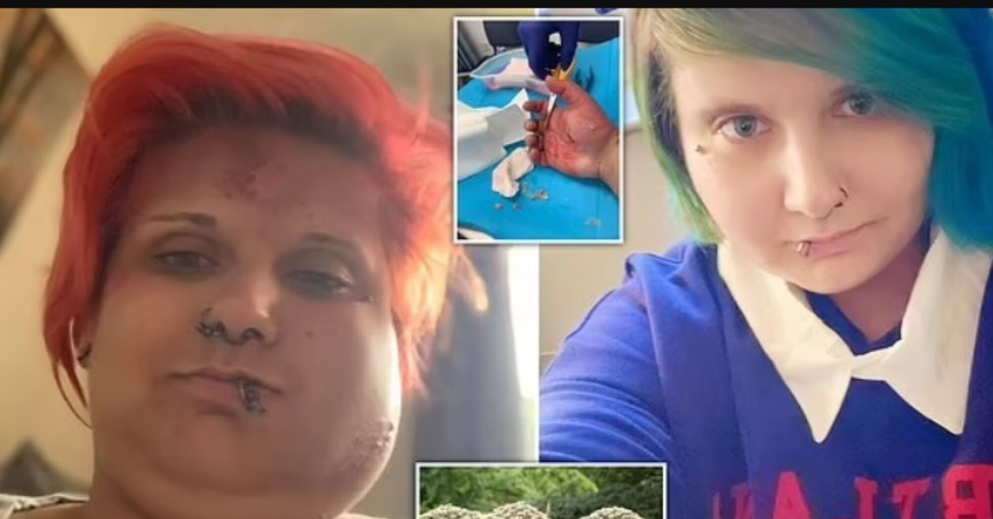 After touching poisonous shrub, a British woman spent a month in the hospital and looked like a Teletubby (photo)