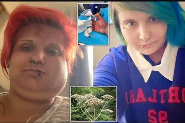 After touching poisonous shrub, a British woman spent a month in the hospital and looked like a Teletubby (photo)