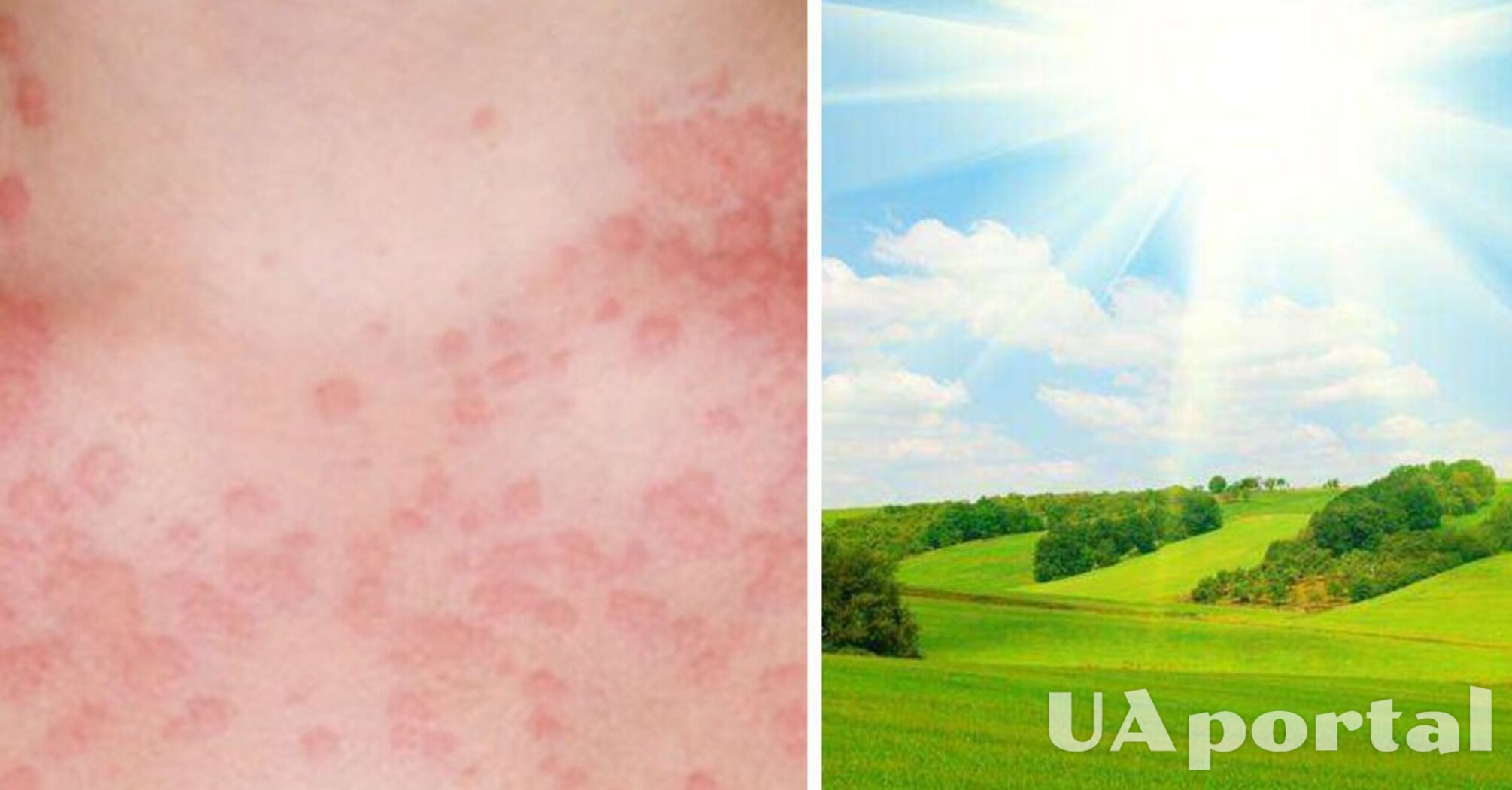 Названі симптоми та причини появи алергії на сонце 