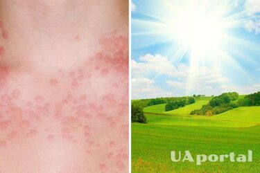 Названі симптоми та причини появи алергії на сонце