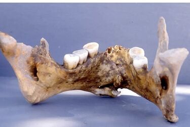 Scientists: Byzantine surgeons in the 14th century knew how to treat jaw fractures with gold, guided by Hippocratic treatises