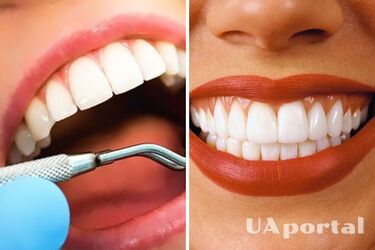 Голівудська усмішка: переваги та недоліки професійного відбілювання зубів 