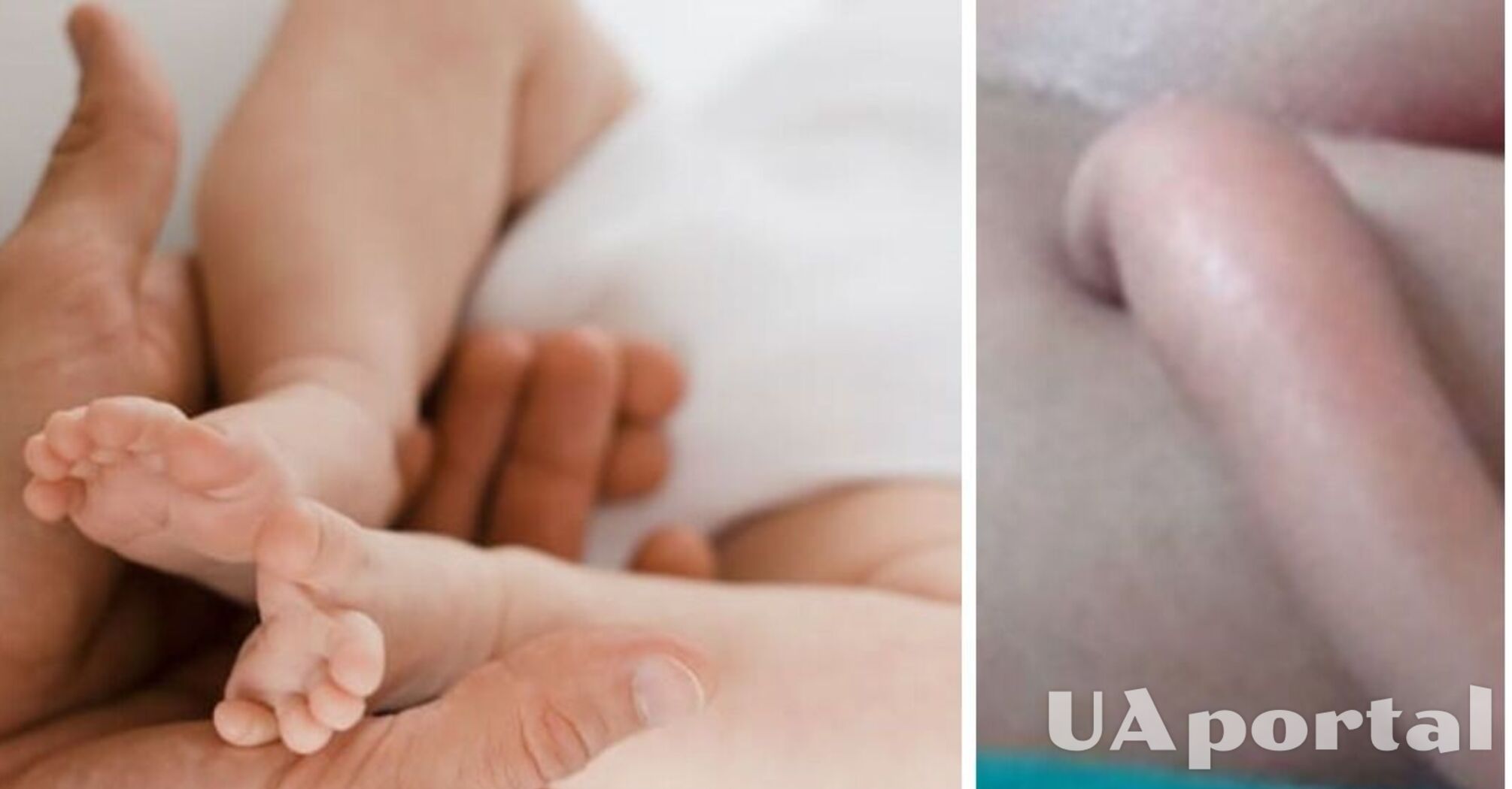 Ученые объяснили, почему некоторые дети рождаются с 'хвостиками'
