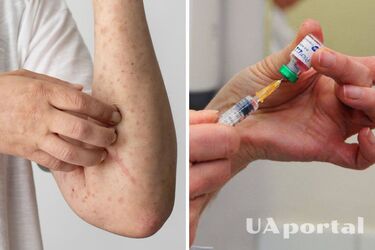 Кір: у МОЗ розповіли про протипоказання до вакцинації