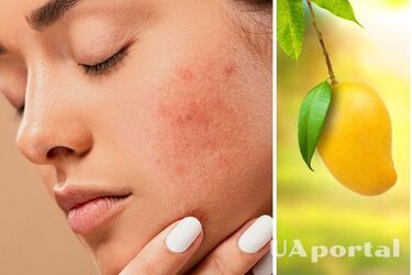 Что нельзя есть, чтобы не вылезли прыщи