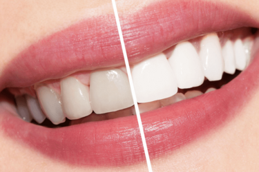 What not to do to keep your teeth from turning yellow