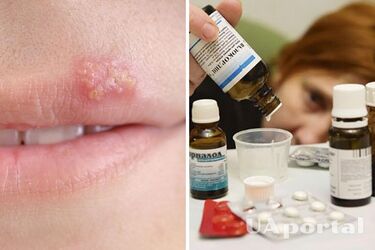 How to get rid of herpes on the lips
