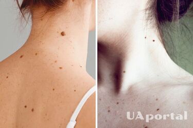 Эксперты ответили, какие родинки на теле приносят удачу