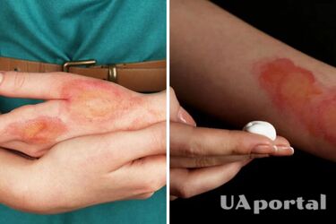 Co zrobić w przypadku poparzenia wrzątkiem: porady lekarzy