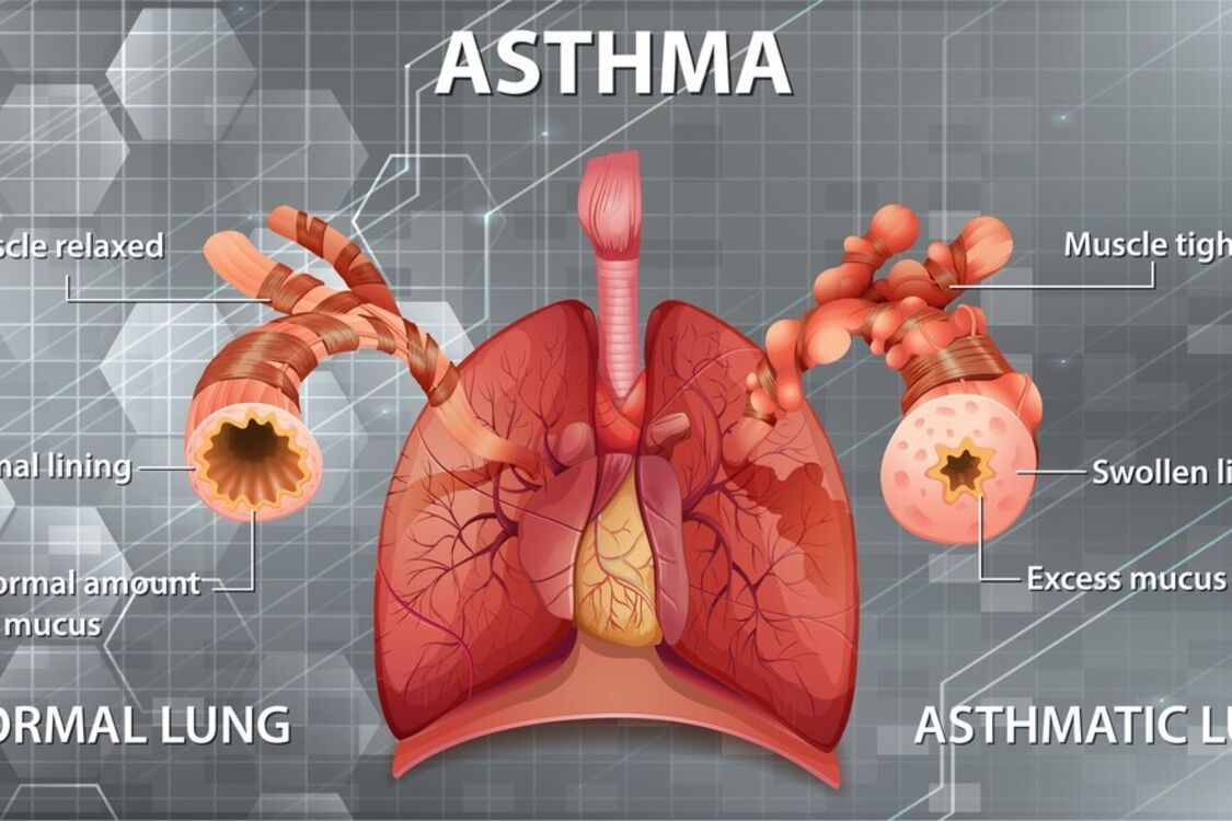 Відомий препарат для астматиків прибирають із аптек