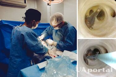 У больного раком китайца врачи нашли пять живых червей (видео)