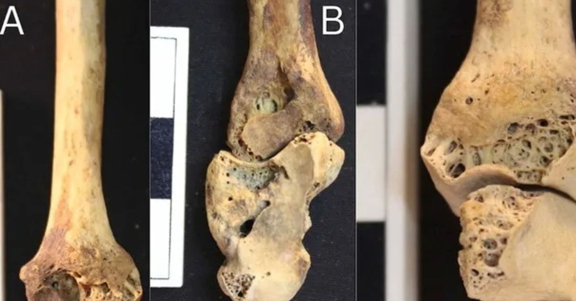 Scientists found a skeleton of a woman with rheumatoid arthritis in Nubia: one of the first examples of the disease